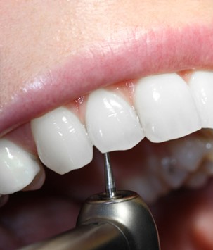 Endodontic Retreatments in Romania