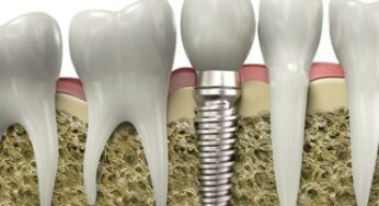 Implants dentaires en Roumanie