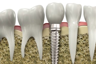 Implants dentaires en Roumanie