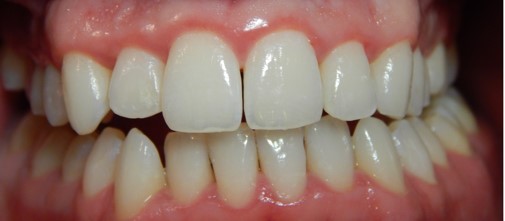 Solutions for Correcting the Gap between Your Teeth