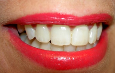Teeth Whitening in Romania