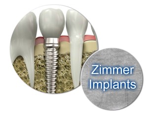 Zimmer Implants in Romania